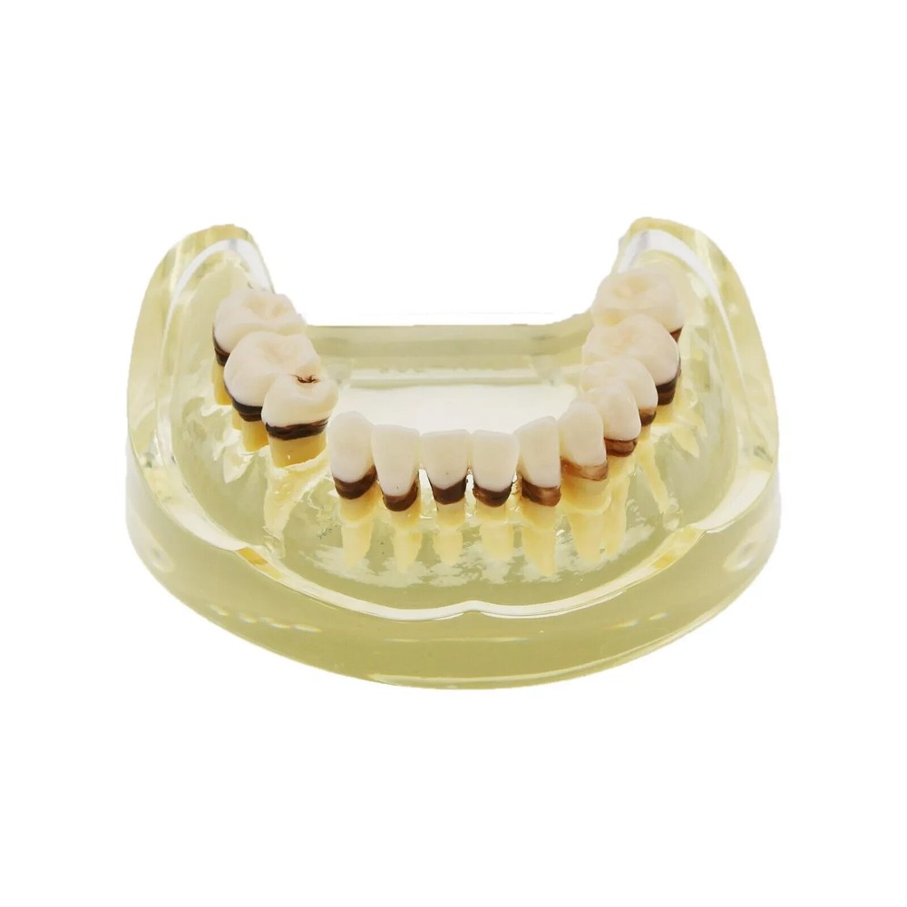 Dental Teeth Model Pathological Disease M4017 Removable Teaching Study Model
