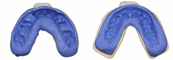 Custom Dental Retainers Upper And Lower- Aligner Type Made by USA Dental Lab