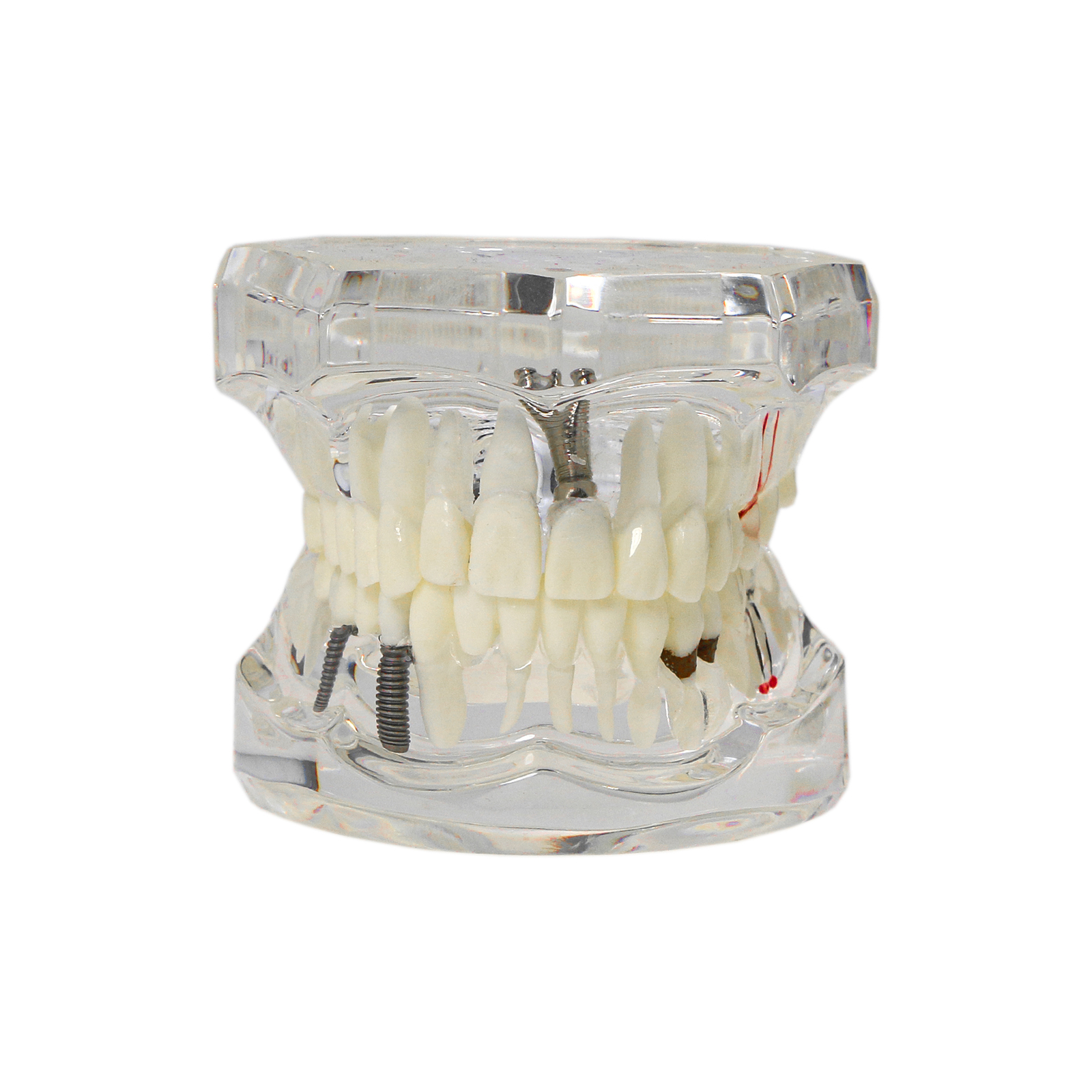 Dental Oral Typodont Model Implant Pathological Teaching Standard Size (Clear)