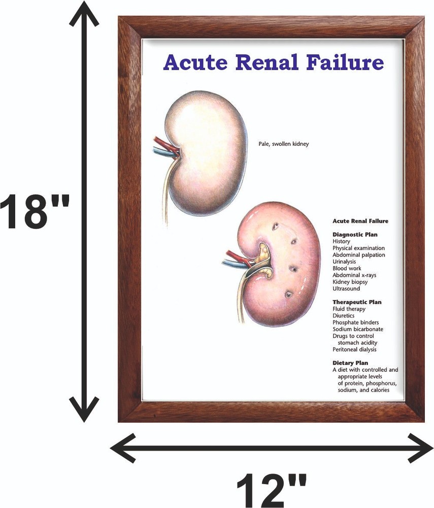 Acute Renal Failure Chart 12x18 inches