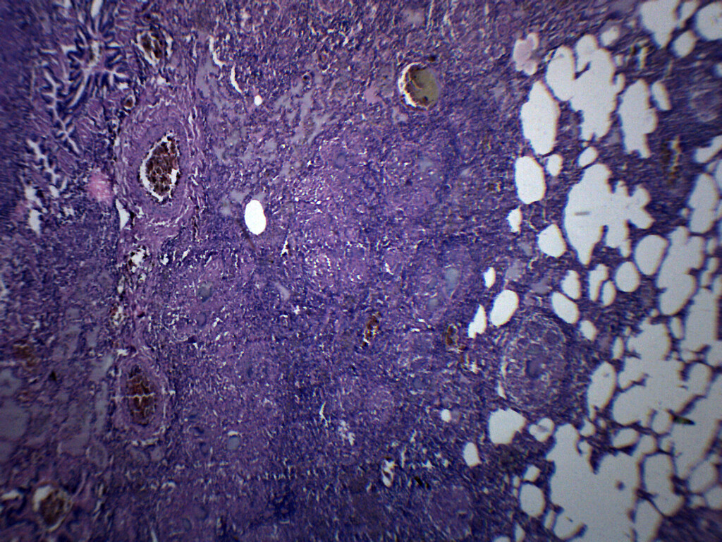 Tuberculosis, Human Lung Section - Prepared Slide - 75x25mm - Eisco Labs