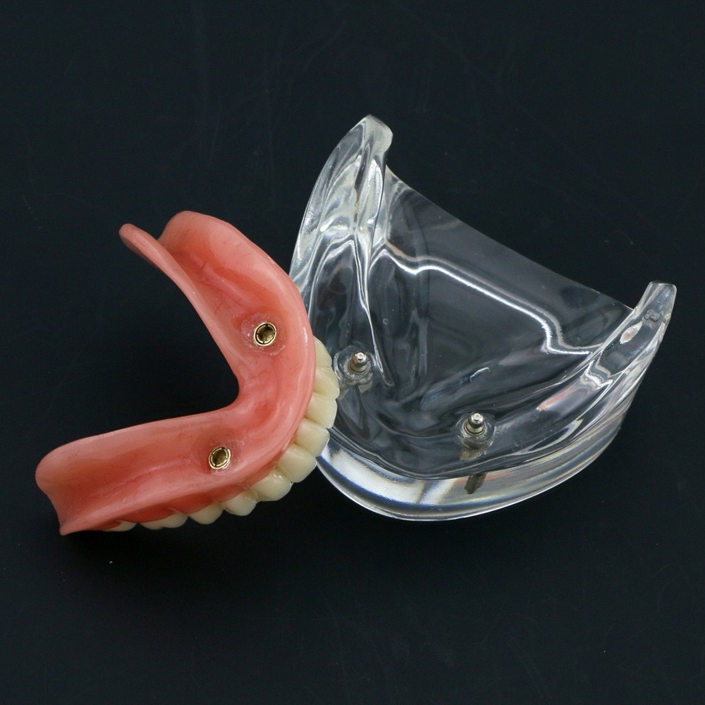 Dental Oral Transparent Upper Teeth 2/4 Implants Model Overdenture Restoration