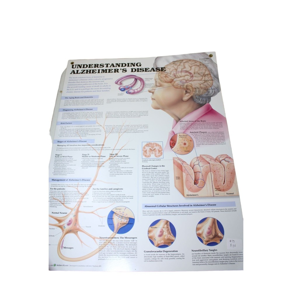 Wolters Kluwer Understanding Alzheimers Disease Chart Schematic 91285