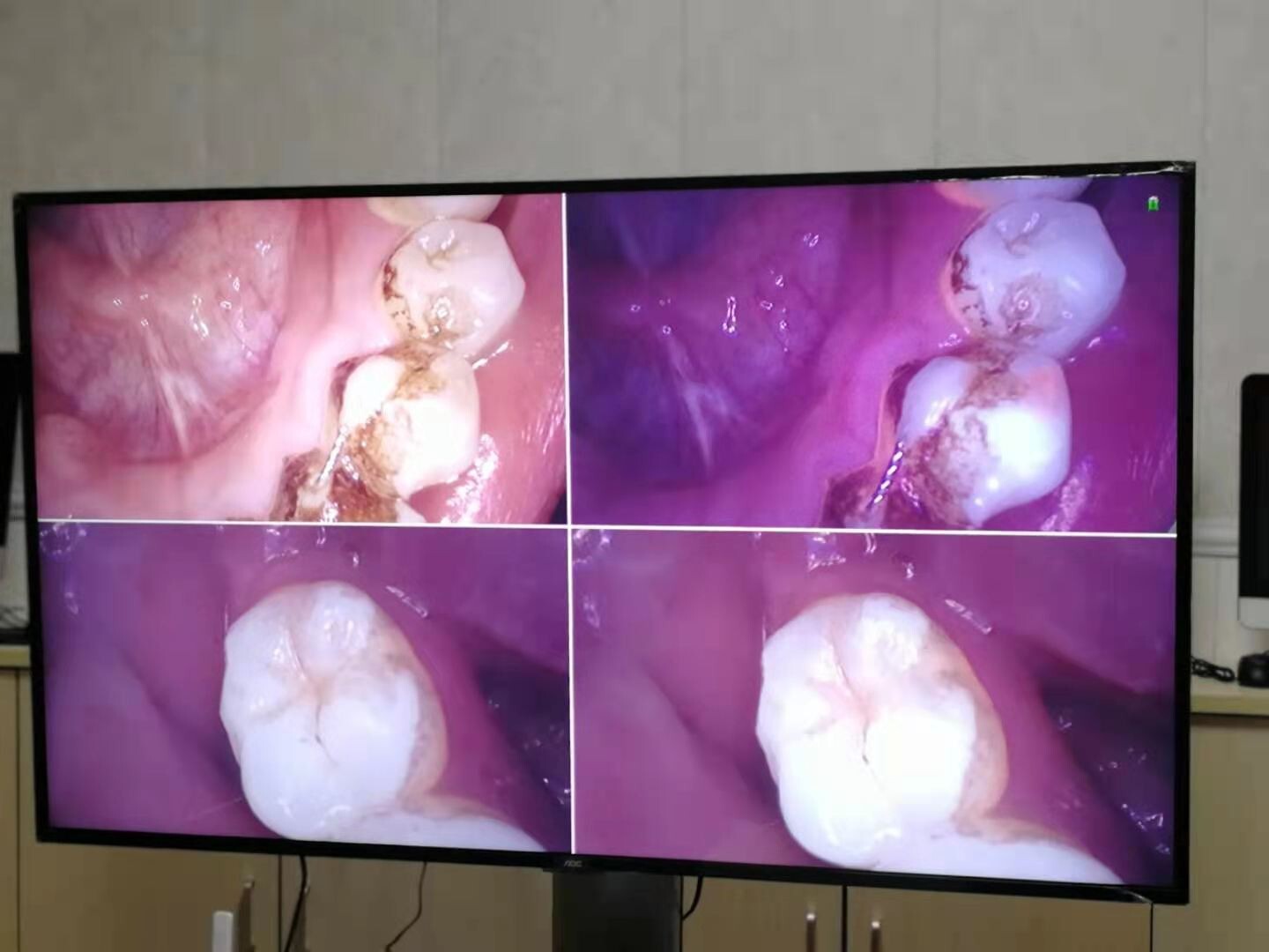 New 1080P Intraoral Camera For Decayed Tooth/Dental Calculas And Plaque MD4000B