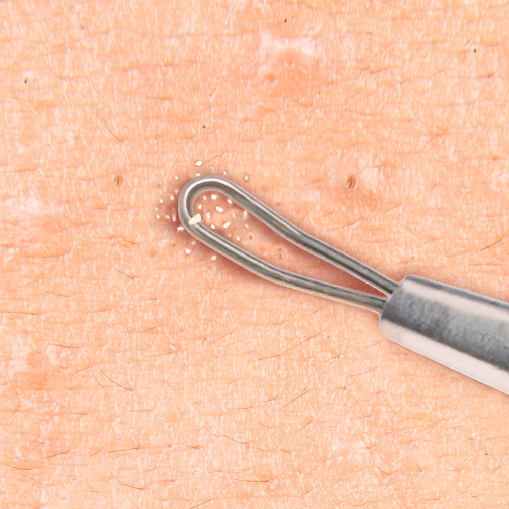 Double Loop Blackhead Remover Pimple Extractor Popper Acne Blemish Comedone Tool