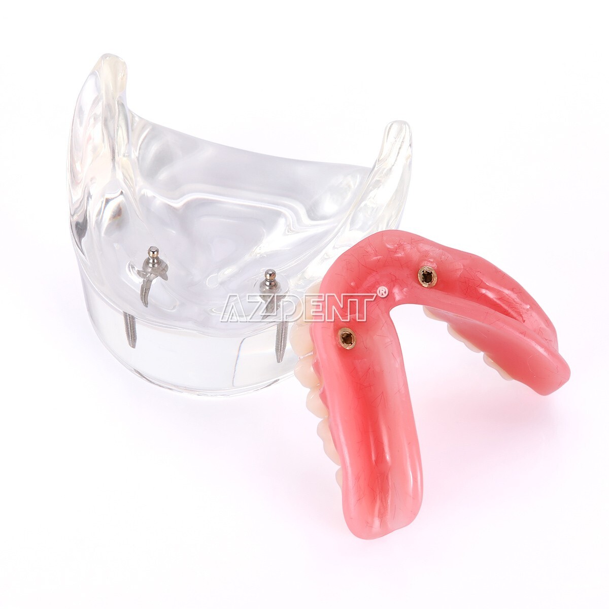 Dental Implant Teeth Model Demo Overdenture Restoration With Implants Lower