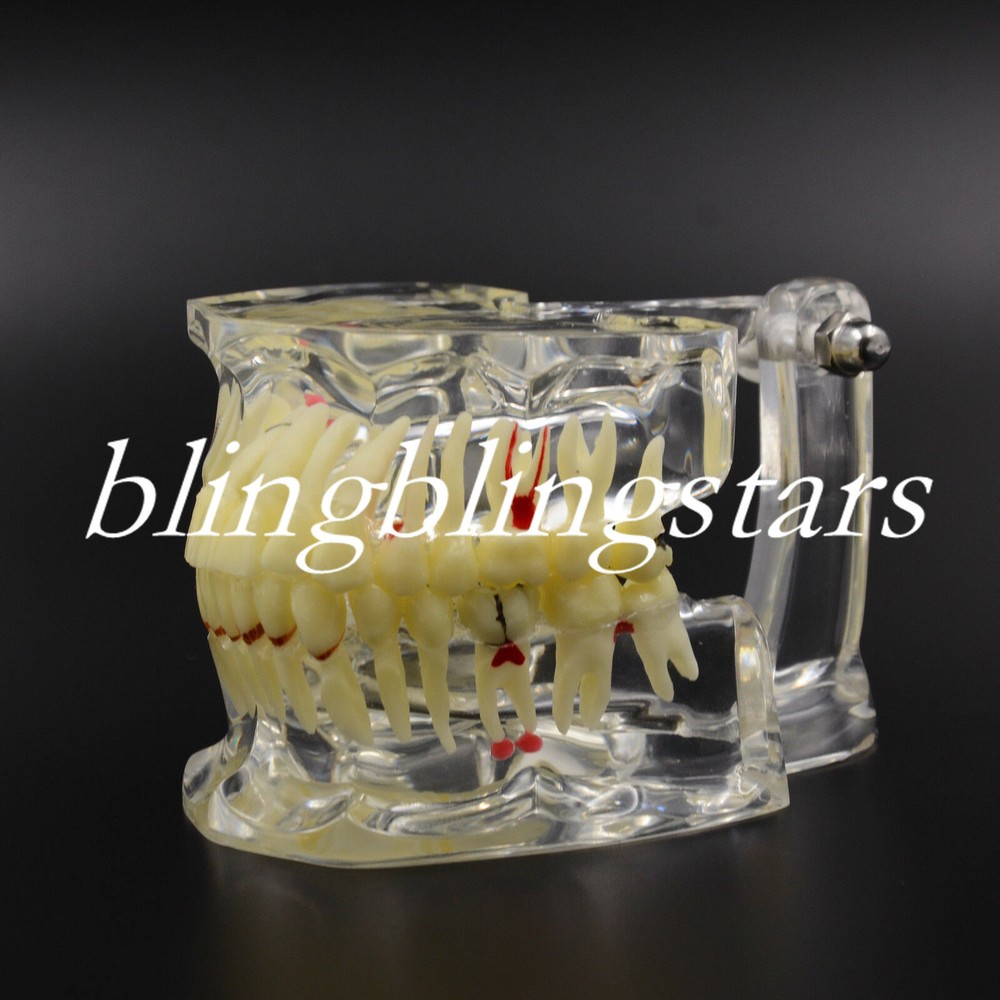 1 Pc Dental Pathological Disease Study Teeth Model Transparent Tooth Dentistry