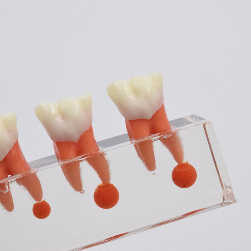 Dental Caries Disease M4018 Study Teaching Model Tooth Correcting Malocclusion