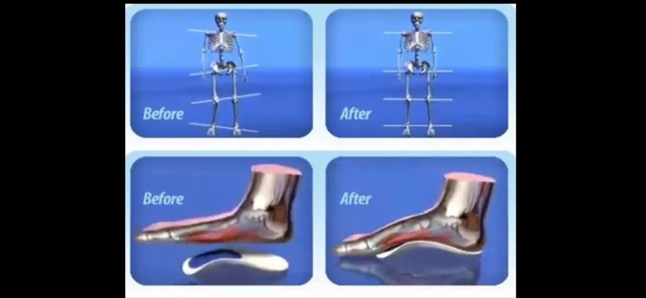 Whieda foot correction insoles foot sole shoe insoles magnets correction 1 pair