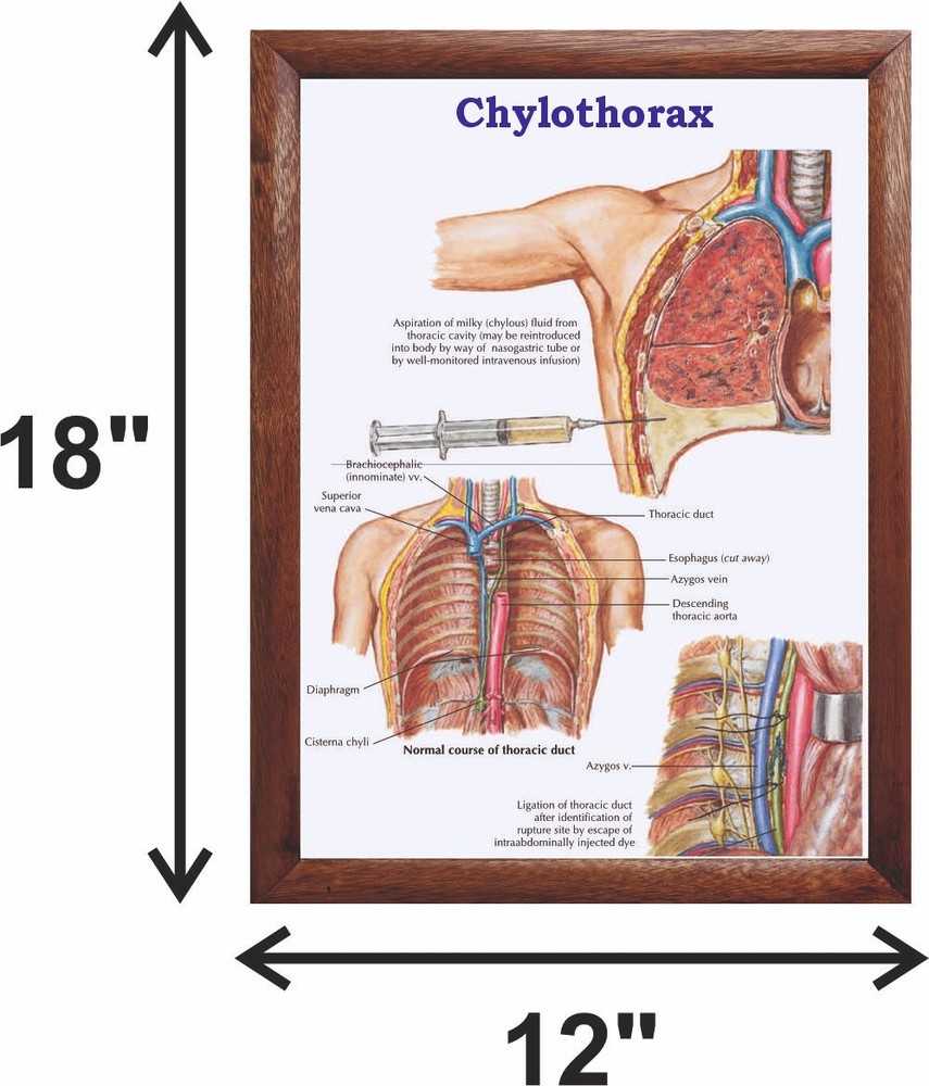 Chylothorax Chart 12x18 inches
