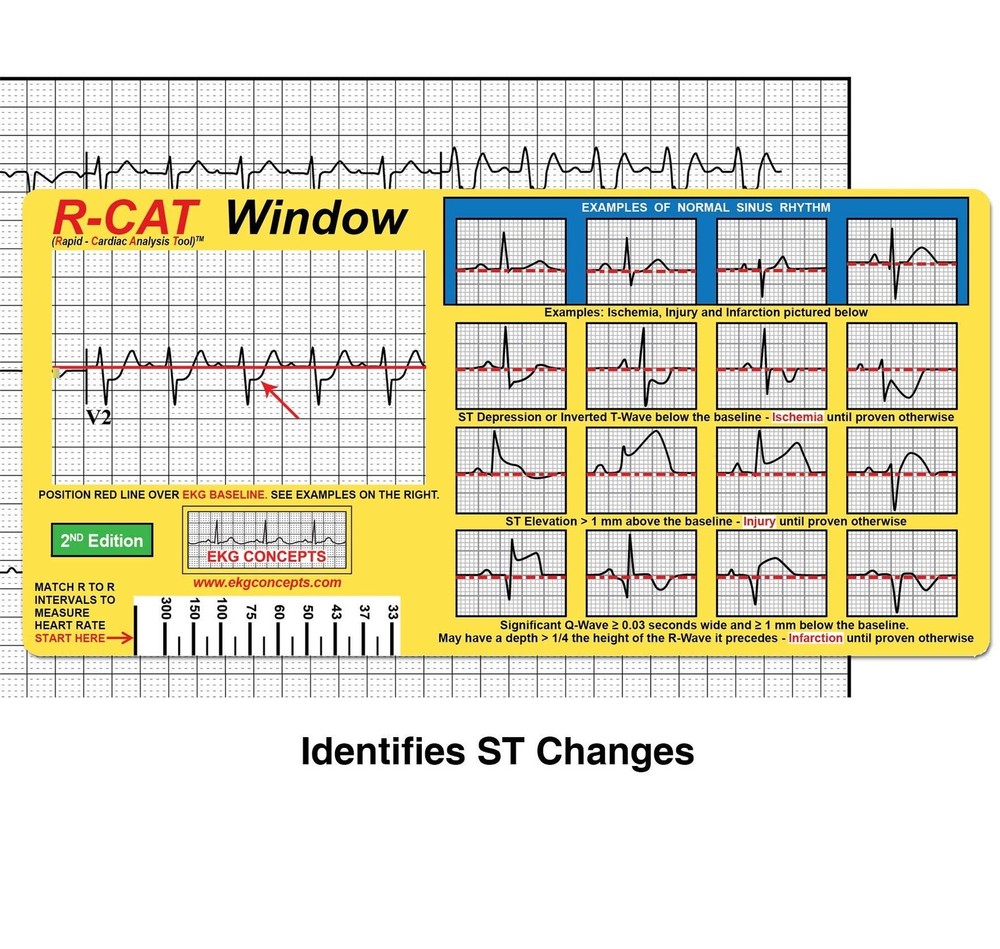 R-CAT EKG Window 2nd Edition