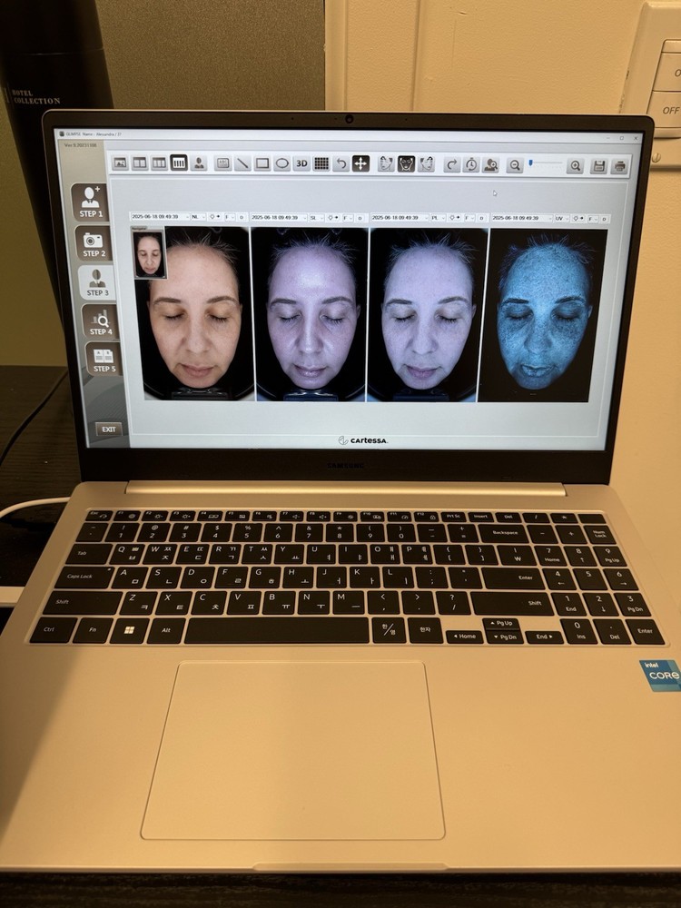 Glimpse Skin Analysis Device