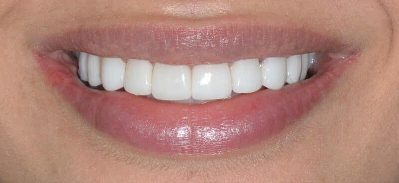 DIY Denture Kit full upper/ full lower False Dentures teeth Home Made Dentures