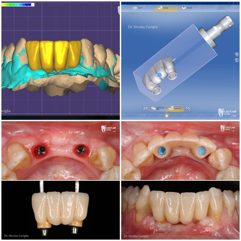 CEREC® Blocks Lithium Disilicate x5