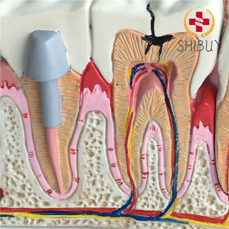 Human Dental Common Pathologies Anatomy Model Dental Model