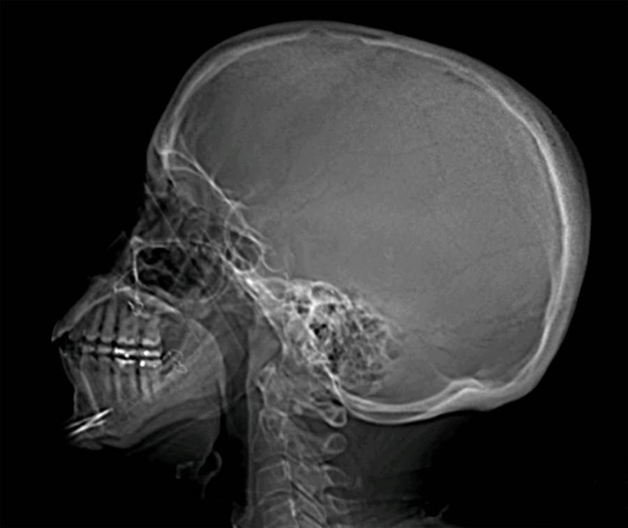 cephalic phosphor plate Size 8 by 10 "
