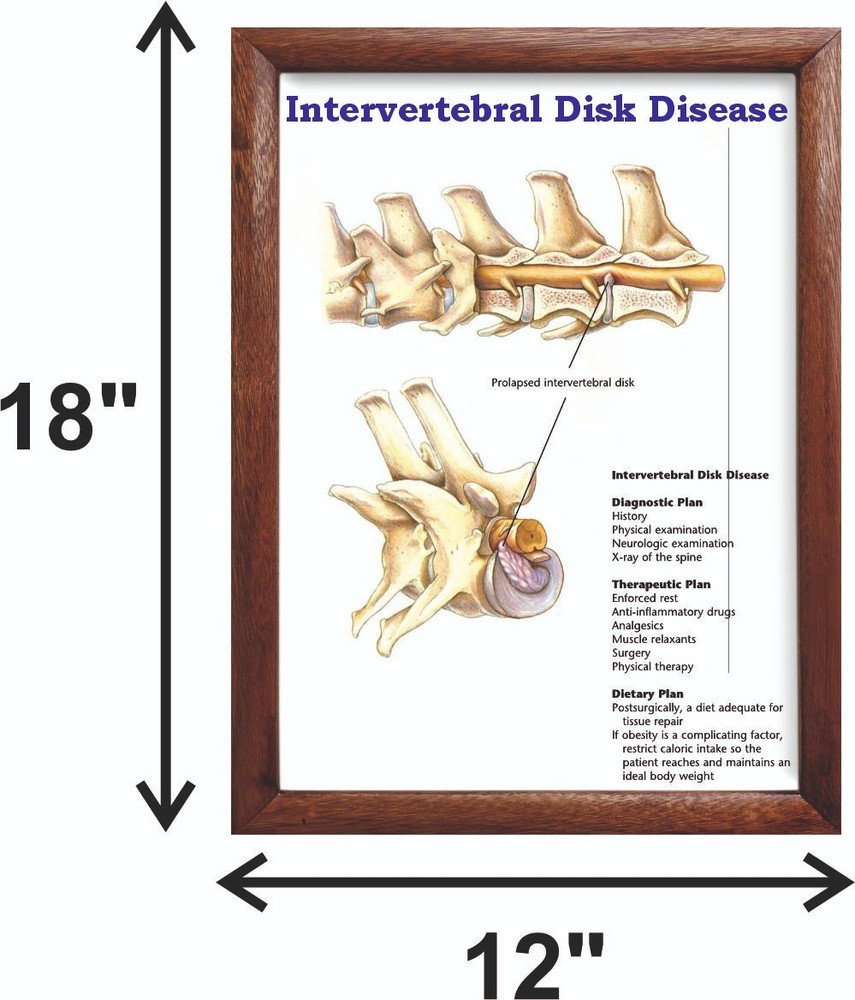 Intervertebral Disk Disease Chart 12x18 inches