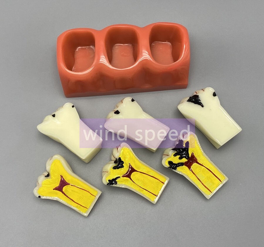 Dental Teaching Model 4 Times Caries Disassembling Comparations Implant Model