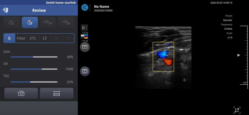 SONON 300L Linear Array Wireless Ultrasound Probe Device