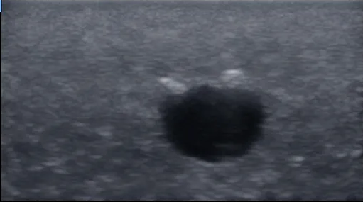 ultrasound phantom cyst model