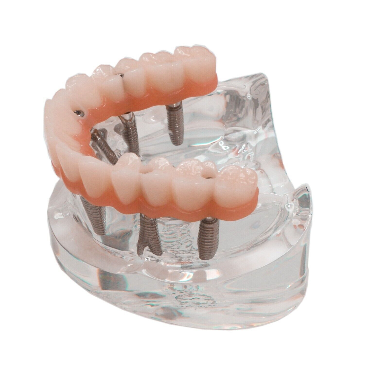 Dental All-On-6 Overdenture Implant Model Demo Upper Jaw 6 Screws Clear M6001-2