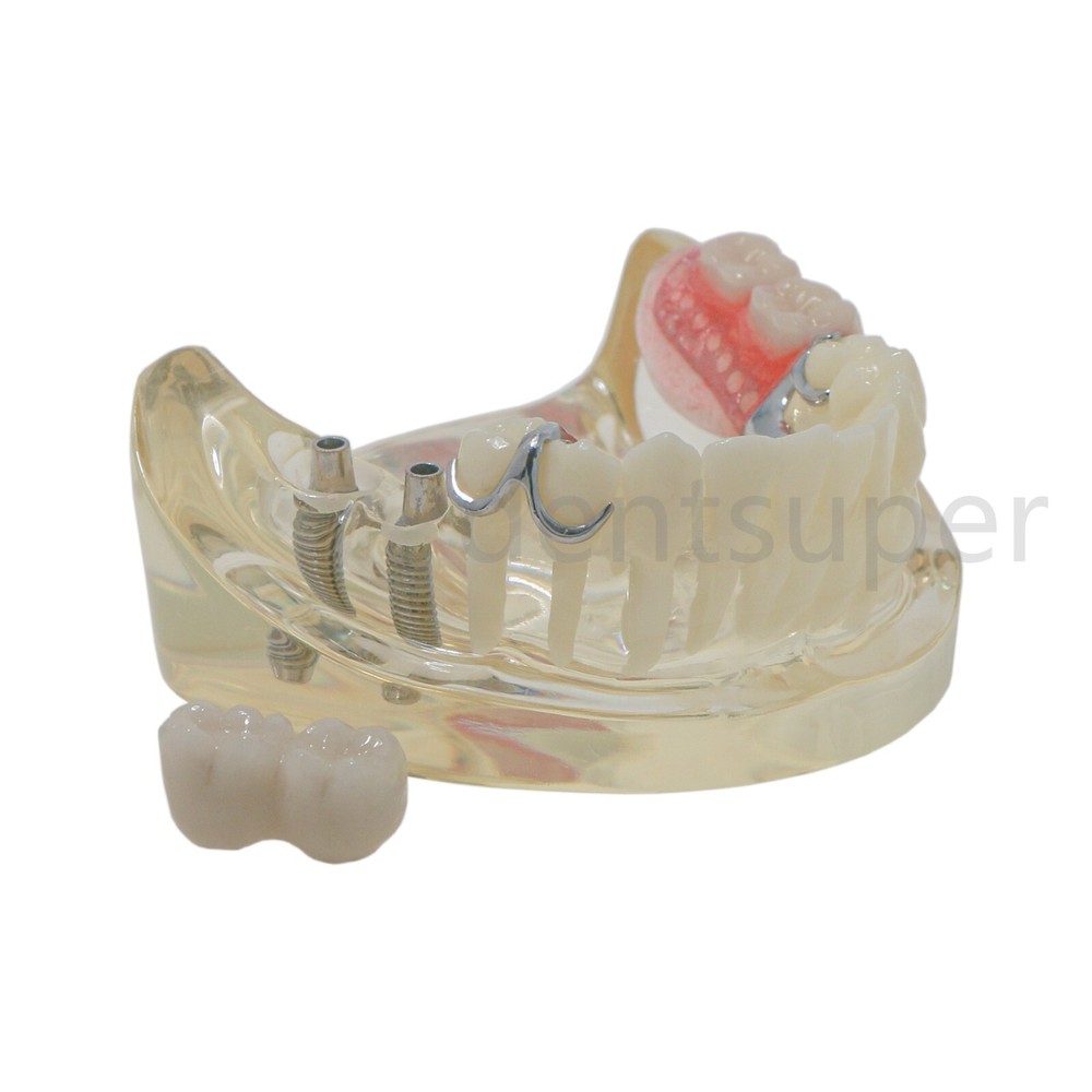 Typodont Restoration Dental Teeth Model With Partial Denture Demo 2 Implants