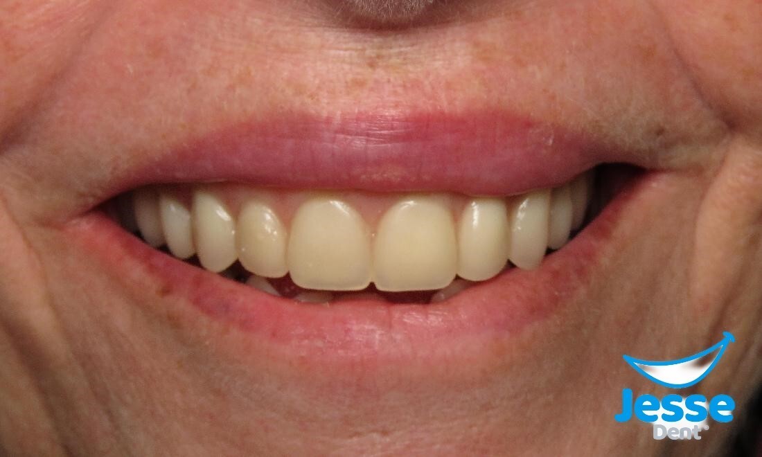 DIY Denture Kit full upper/ full lower False Dentures teeth Home Made Dentures