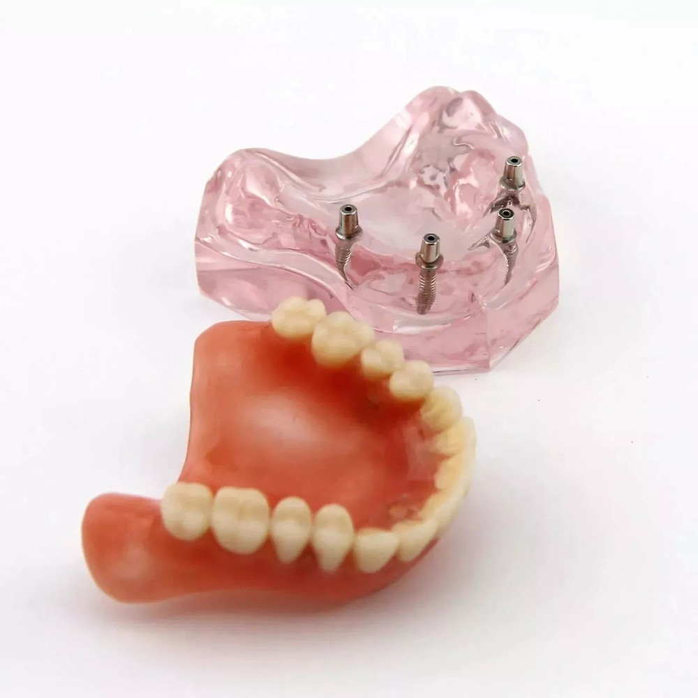 7 Types Dental Overdenture Restoration Model Implants Typodont Teaching Study