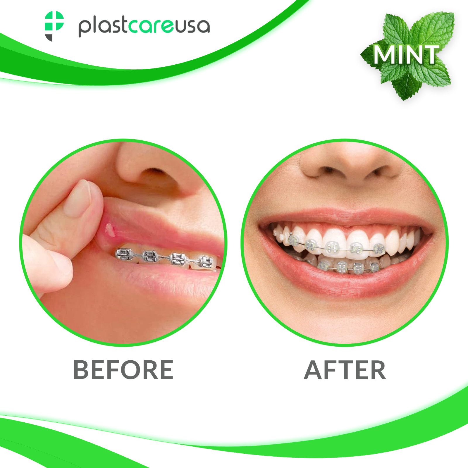 Mint Orthodontic Wax for Braces Clear Dental Wax Strips Brackets Wires, 50 Packs