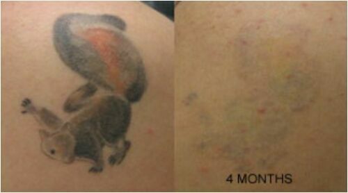 Tattoo Removal Cream Natural Fading system wrecking balm