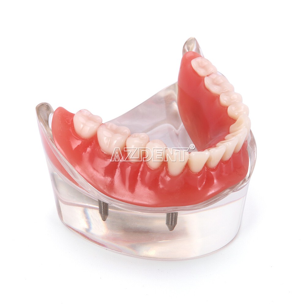 Dental Implant Teach Study Model Demo Overdenture Typodont 4Implants Upper Lower