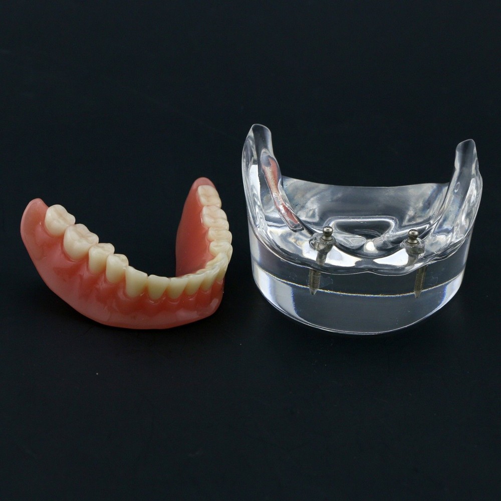 Dental Oral Transparent Upper Teeth 2/4 Implants Model Overdenture Restoration