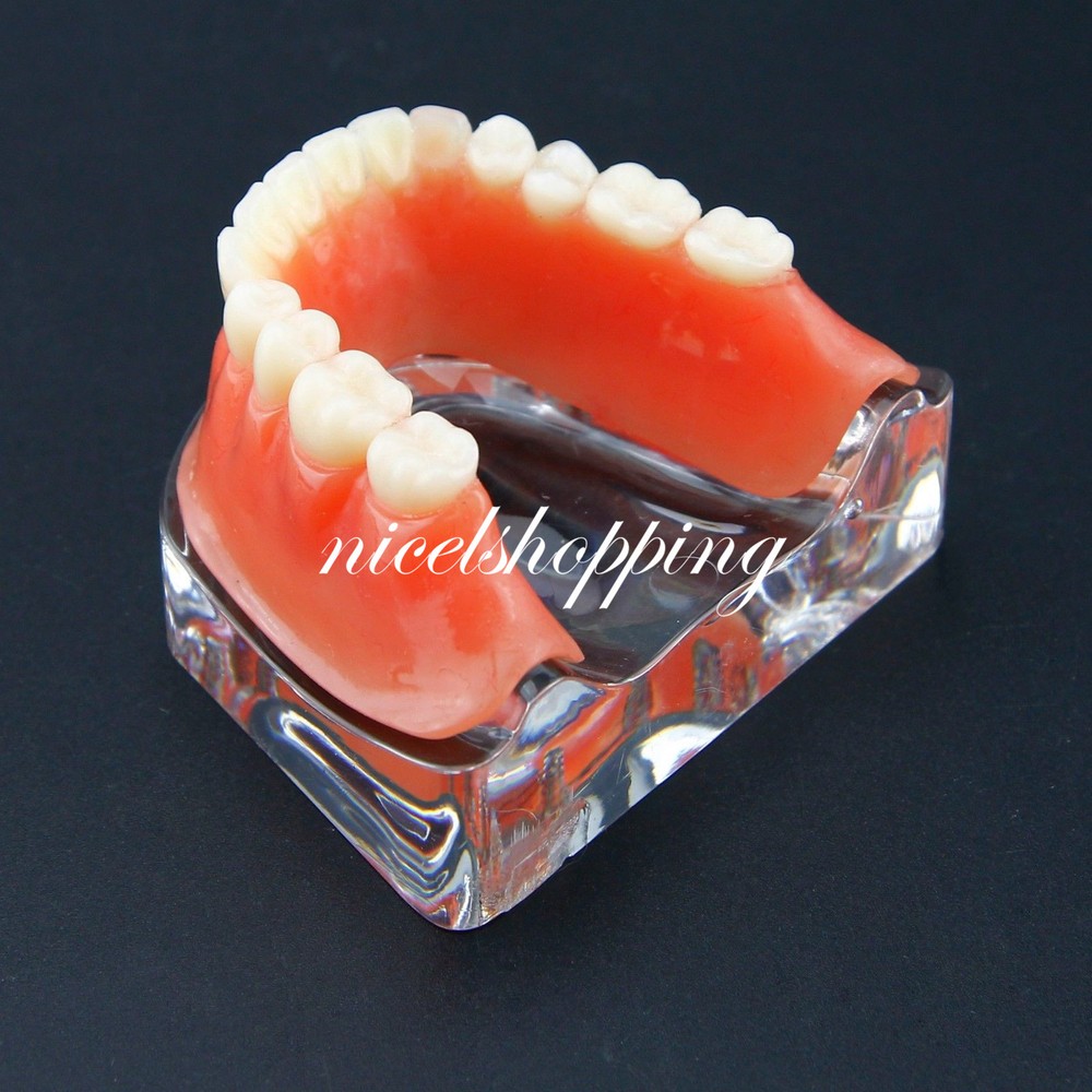 Dental Inferior Overdenture Model Lower Precision Implants With Silver Bar #6009