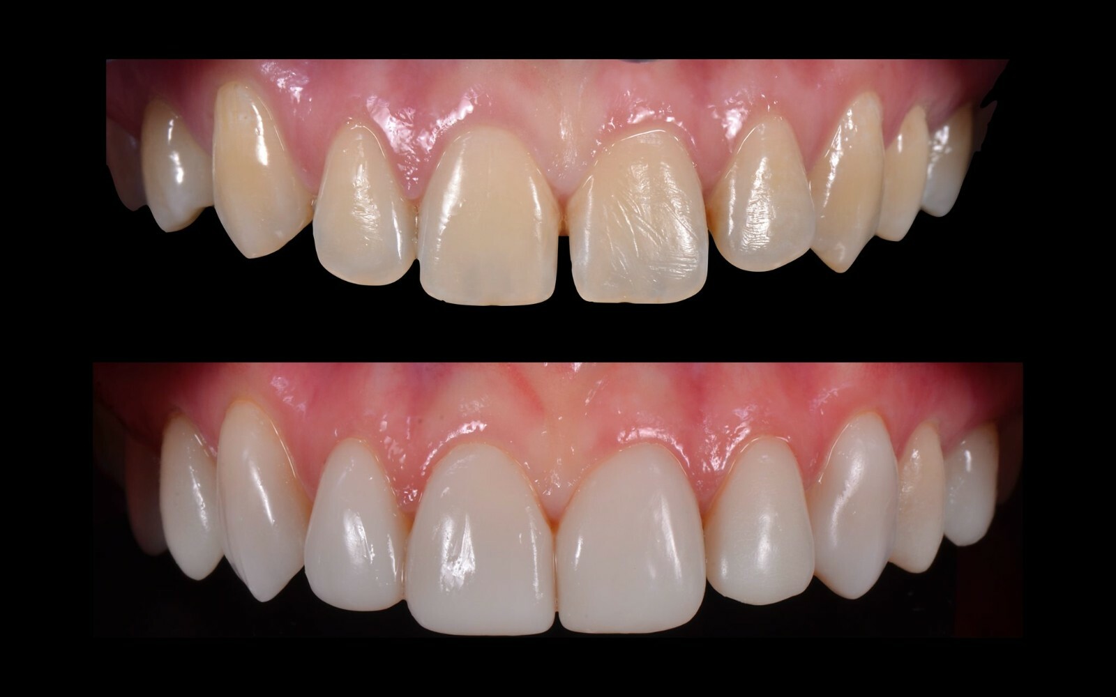 DLP SLA LCD 3d printer permenant crown - teeth resin ..