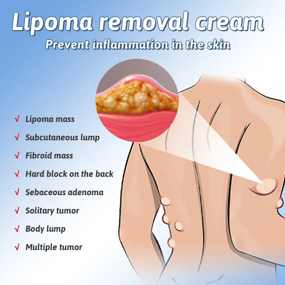 50ML Lipomheilung Reduction Spray, Instant LumpFree Lipoma Removal Spray