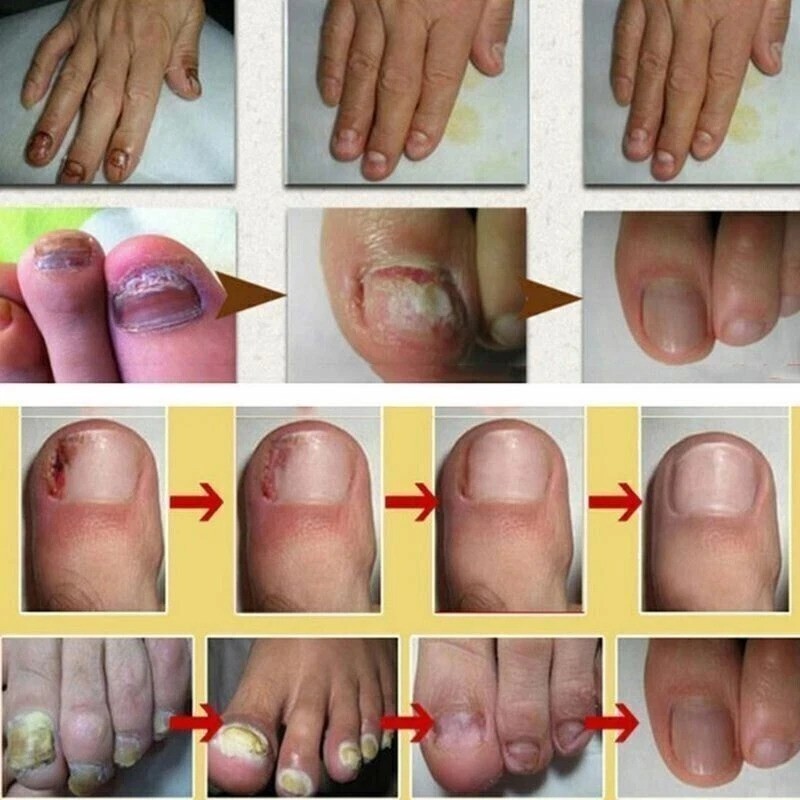 (The Latest ) # Nail Fungal Lacquer 2.5ML FREE & FAST SHIPPING World Wide