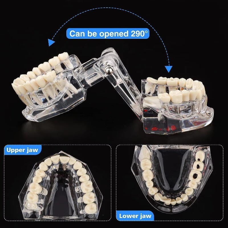 Medical Pathological Extrusion Missing Teeth Model Dental Teaching Teeth Model