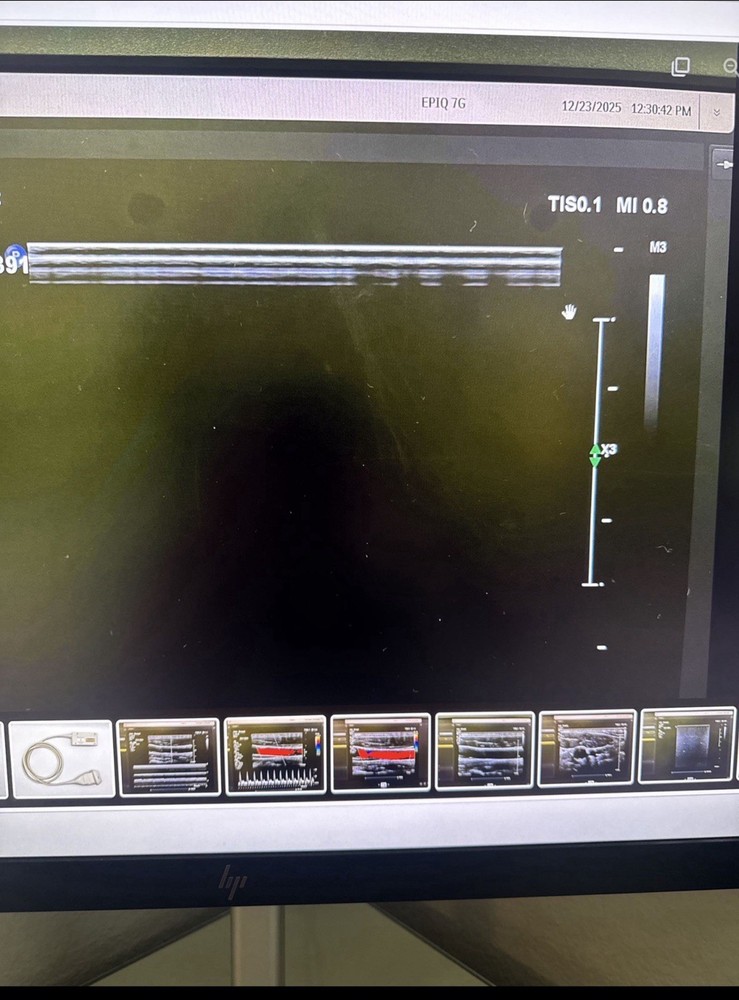 Philips L18-5 liniar array compact Transducer Probe (crystal dropout)