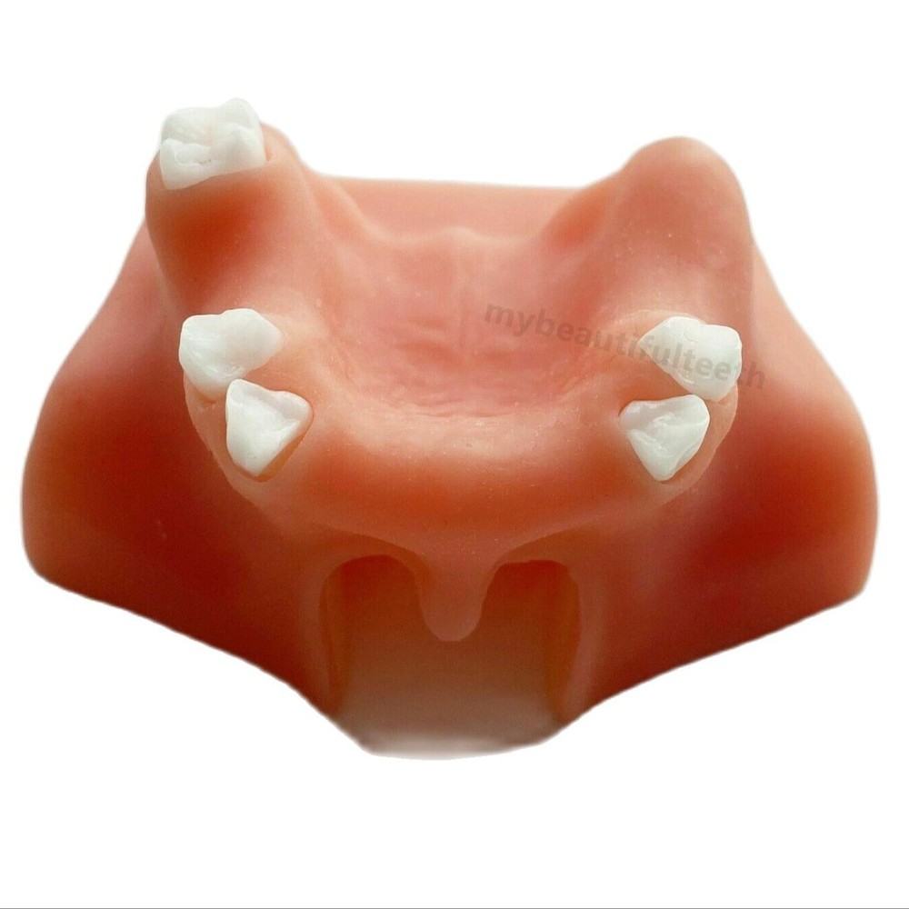 Dental Teeth model with Maryland Bridge Caries Teach Study Model