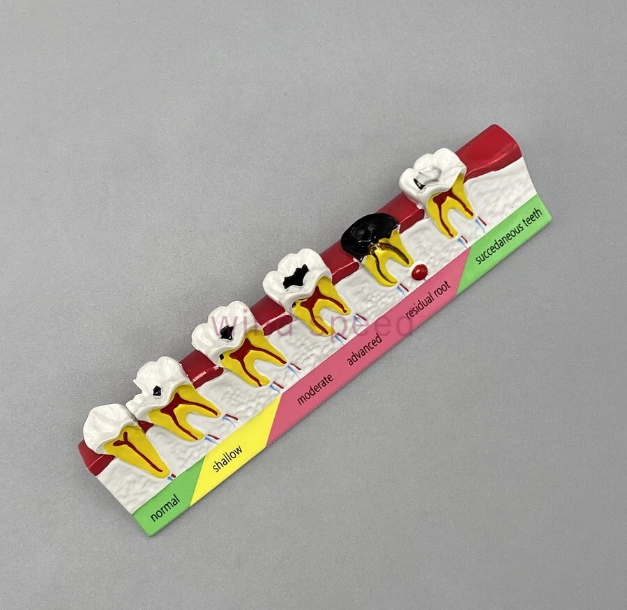 Dental lab Study Teaching Models Caries Disease Assort Teeth Dentoform Model