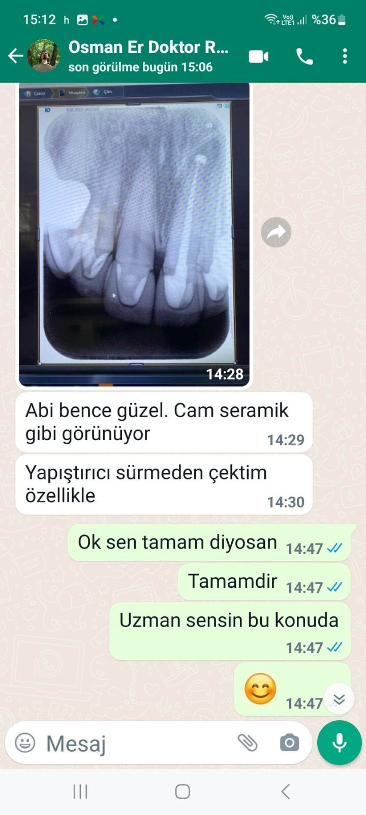 DLP SLA LCD 3d printer permenant crown - teeth resin ..