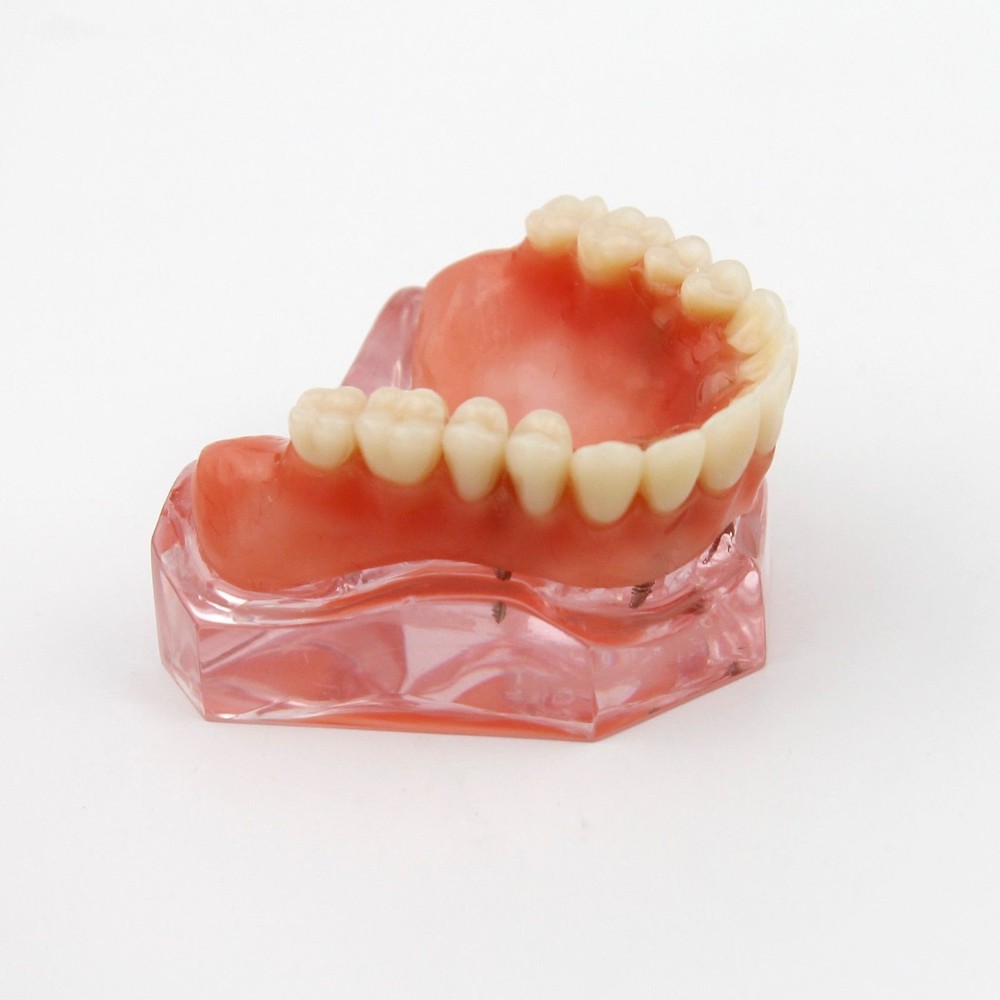 Dental Implant Teeth Model Demo Overdenture Restoration Teaching Study 4 Models