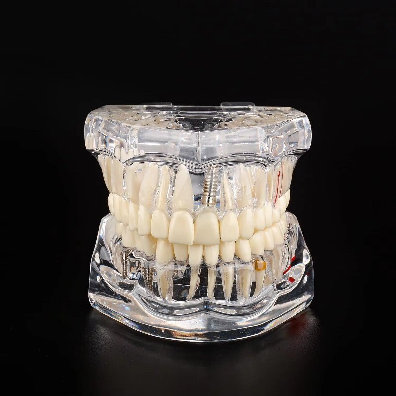 Medical Pathological Extrusion Missing Teeth Model Dental Teaching Teeth Model