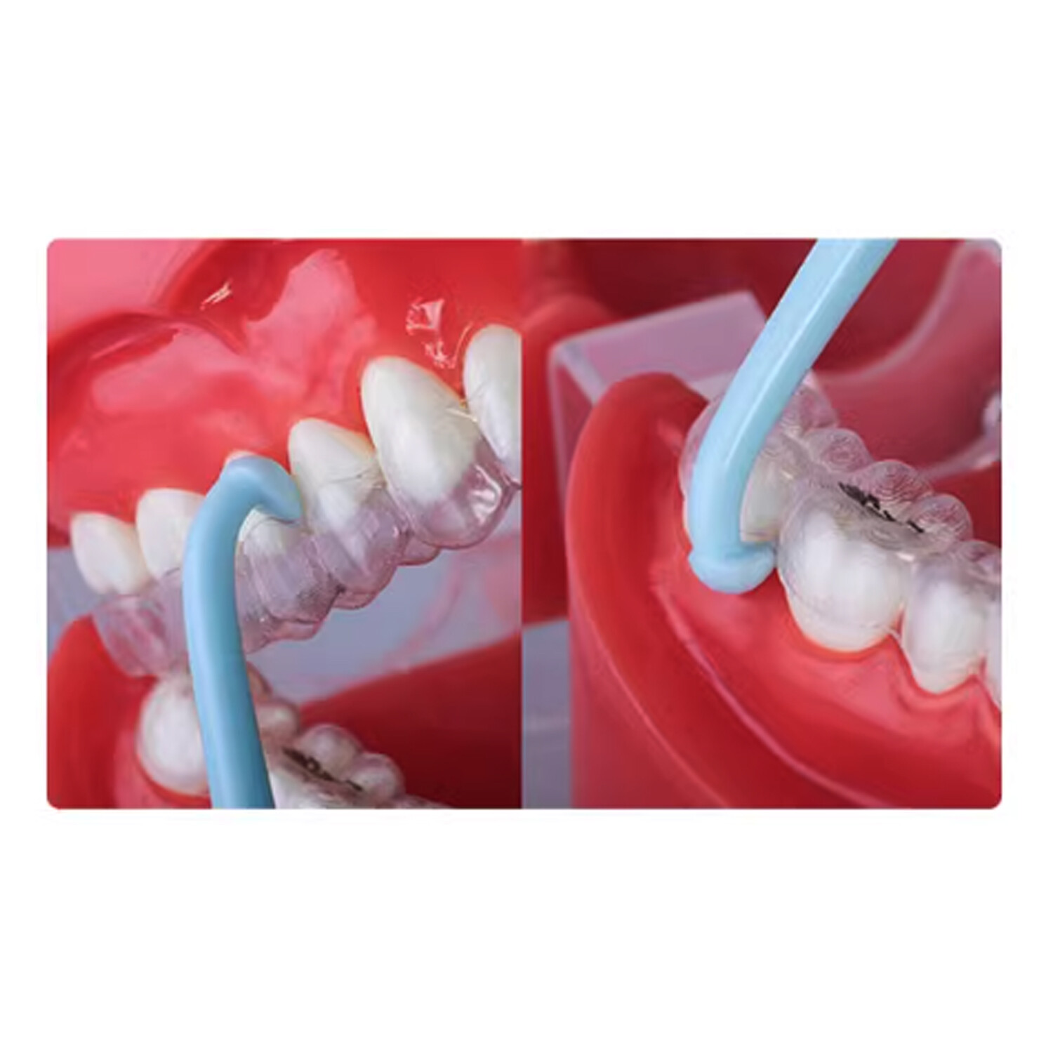 J&J Ortho Dental Orthodontic Aligner Remover Hook Retainer Retriever (10/pk)