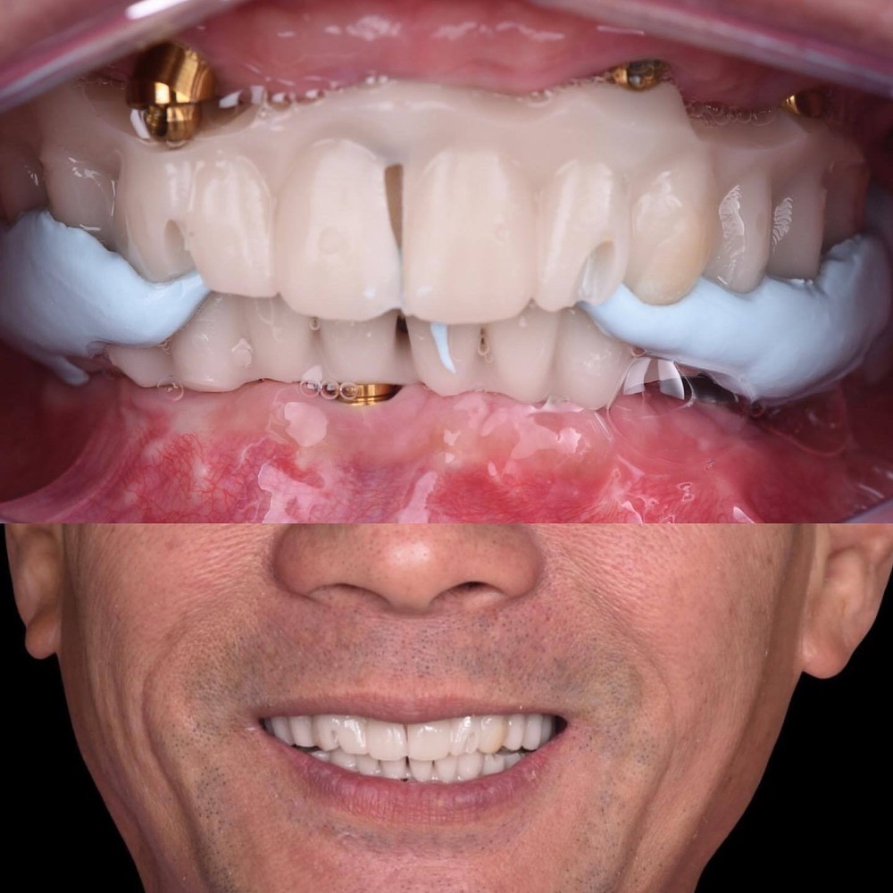 DLP SLA LCD 3d printer temporary teeth resin ..