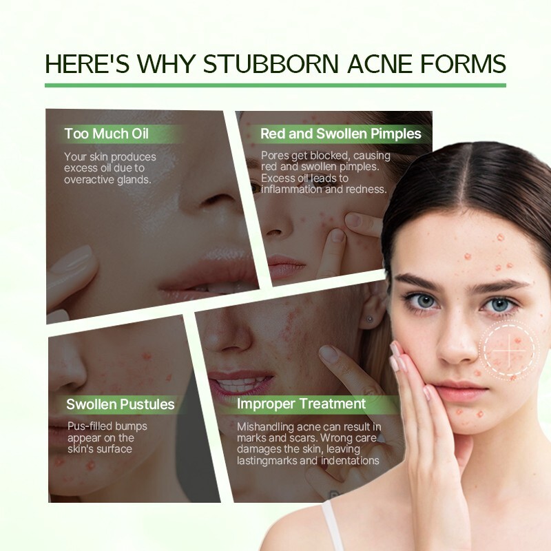 Severe Acne Pimple Treatment Serum Cystic Spot Remover Reduce Redness Swelling