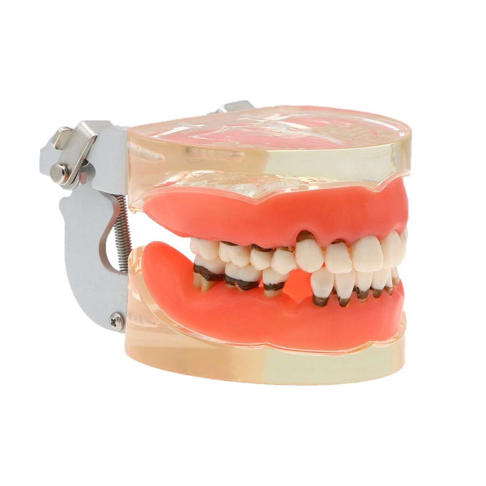 Dental Typodont Teeth Model Pathological Perio Implant Endo Caries Teeth Model