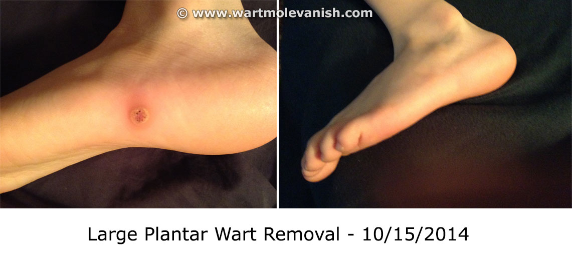 Mole Remover, Wart Remover, Skin Tag remover, Wart Mole Vanish™ Award Winning