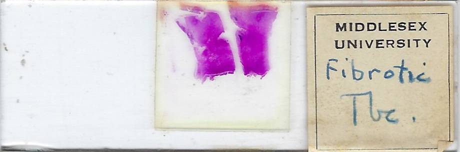 Human Fibrotic Tuberculosis Pathology Microscope Slide